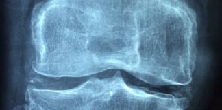Bis zu acht Millionen Menschen in Deutschland leiden an Arthrose. Foto: pixabay