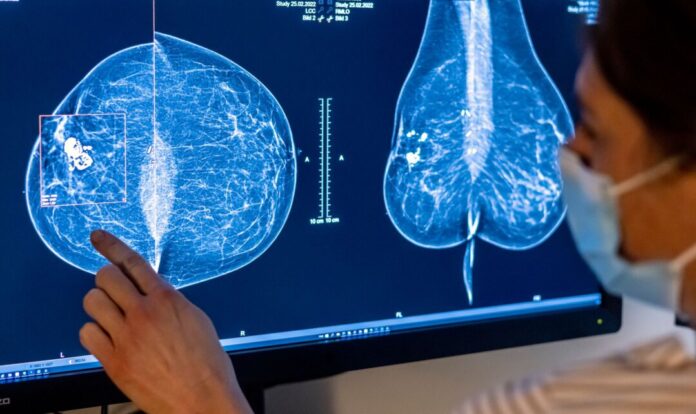 Mammographie Medizinisches Personal untersucht mit einer Mammografie die Brust einer Frau auf Brustkrebs. (Archivbild)